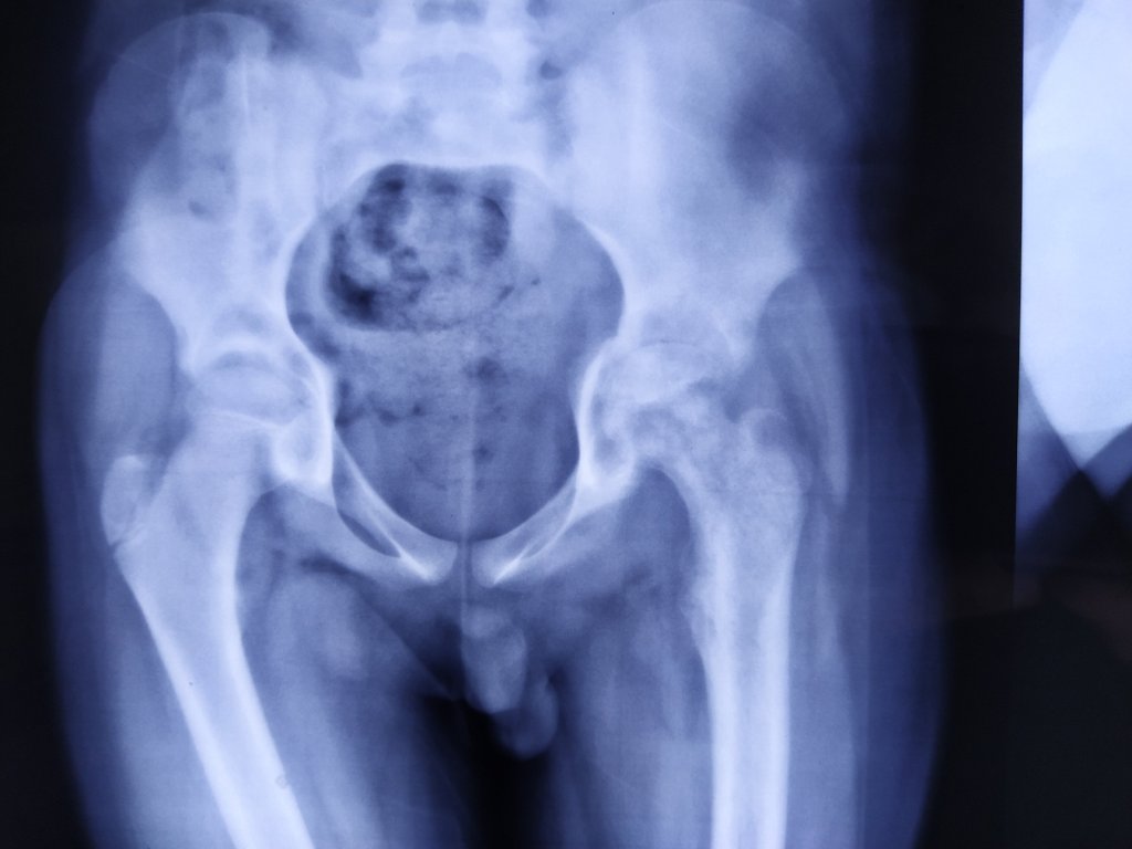 Septic Arthritis of the Hip joint