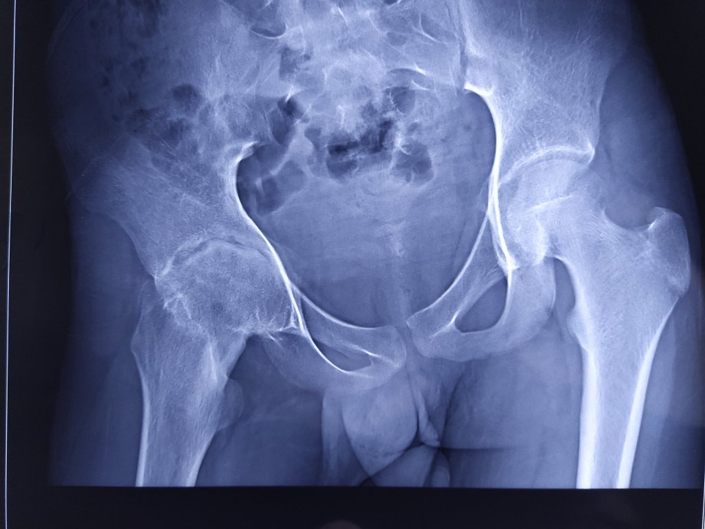 Tuberculosis of the Hip Joint